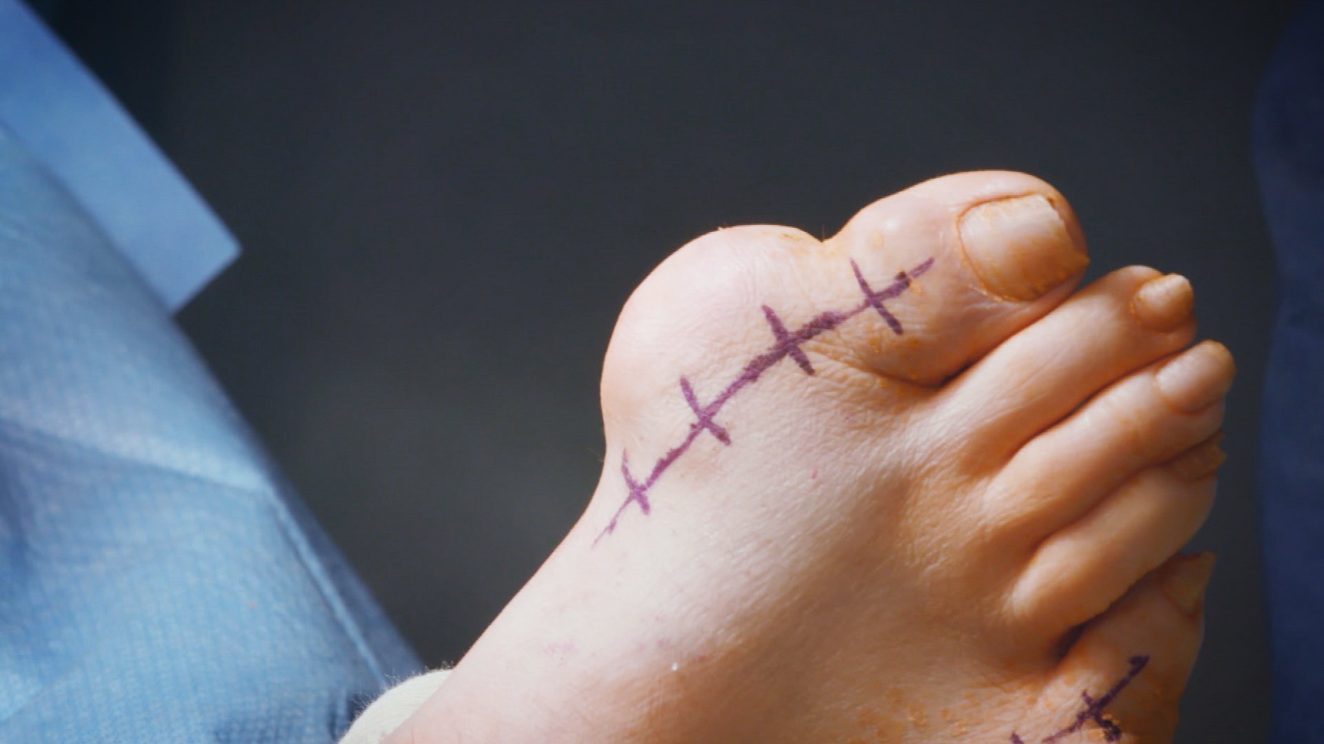 2. Hammerhead Foot