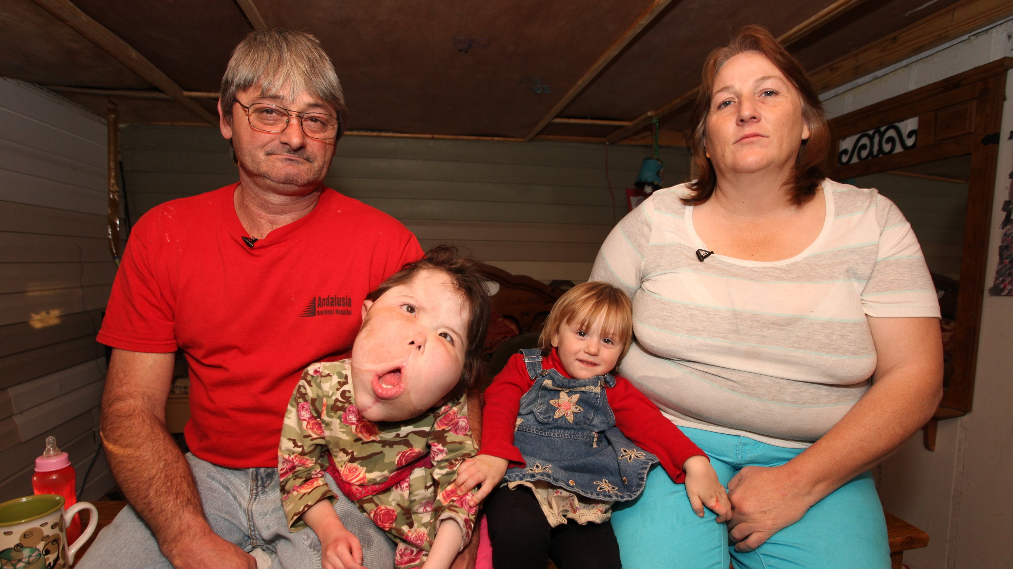 4. Siamesiska tvillingar